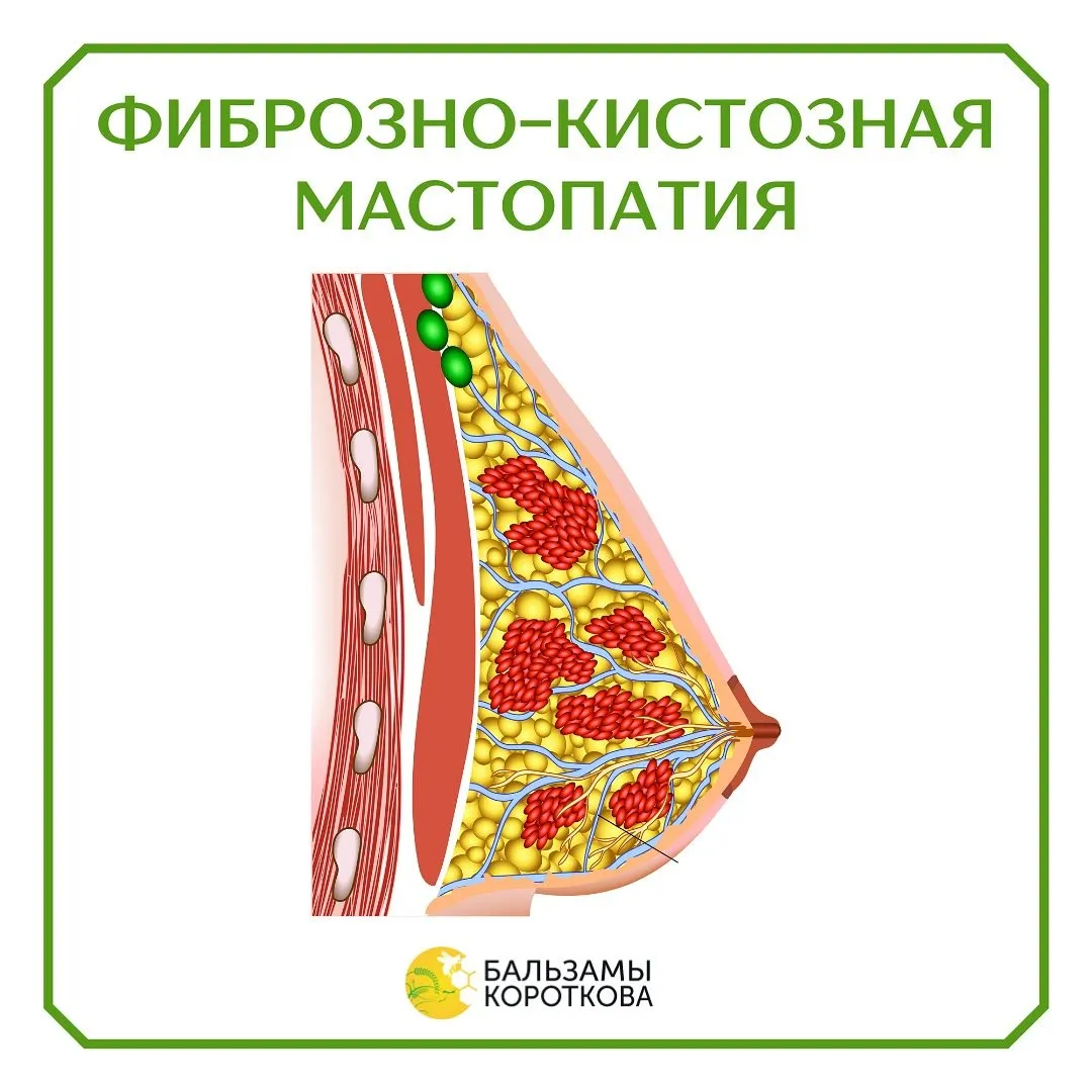 Фиброзно-кистозная мастопатия